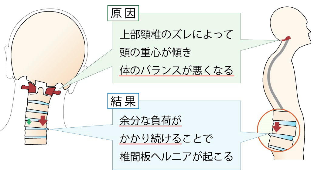 椎間板ヘルニアの原因を説明