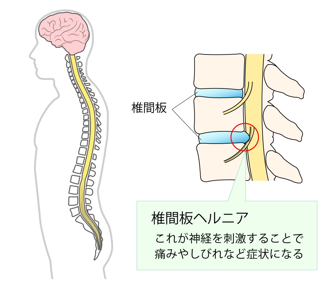 椎間板ヘルニアのイラスト